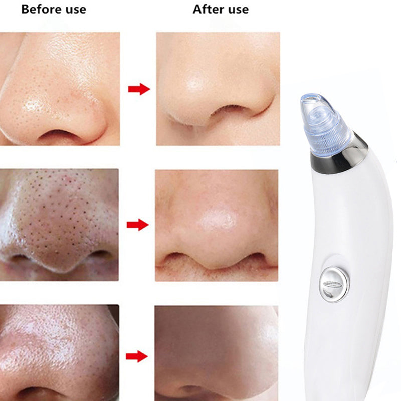 4 in 1 Derma Blackheads Remover Machine